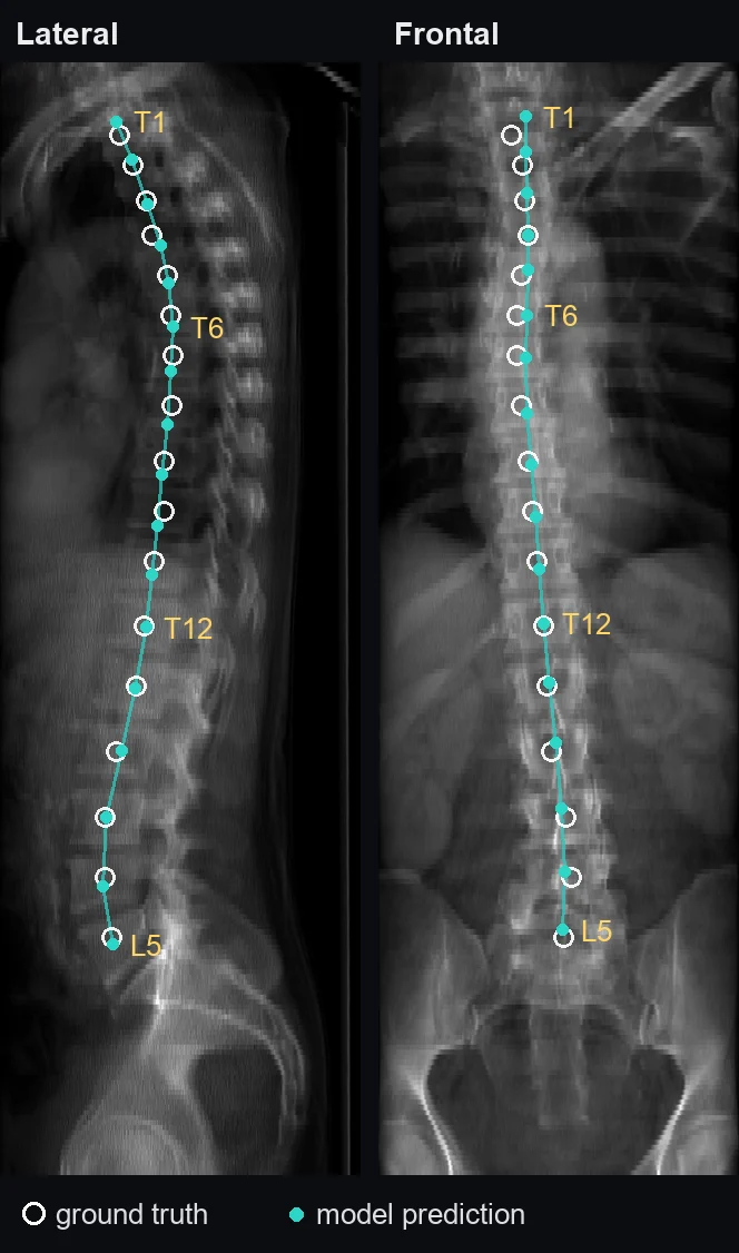 Lateral and frontal radiographs with predicted vertebral centroids closely matching ground-truth markers from T1 to L5