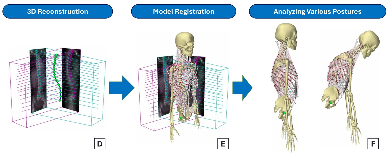 Pipeline from biplanar radiograph landmarks to 3D reconstruction, model registration, and posture simulation