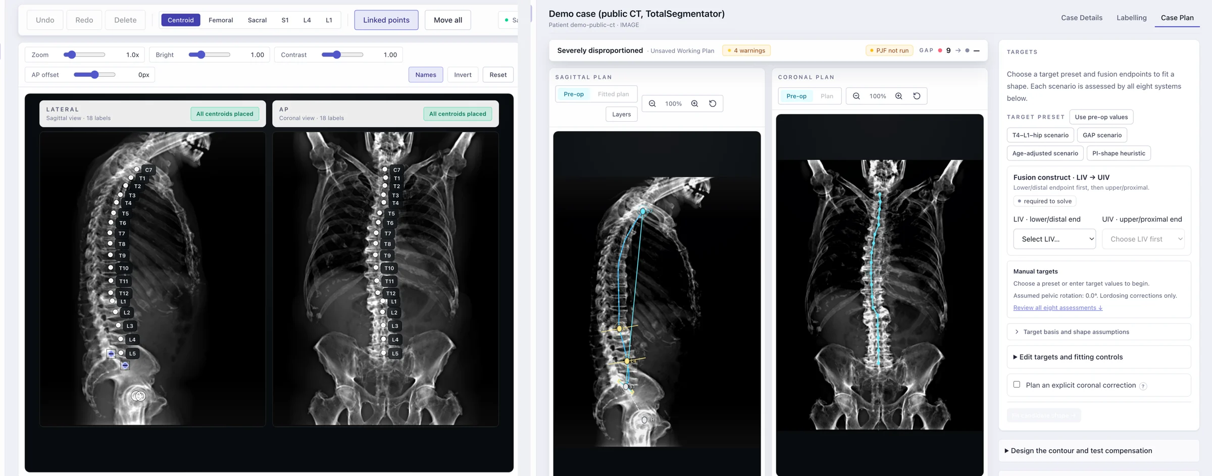 Zyra workstation: labelled lateral and frontal radiographs with vertebral centroids, and the planning view with sagittal and coronal curves and target presets